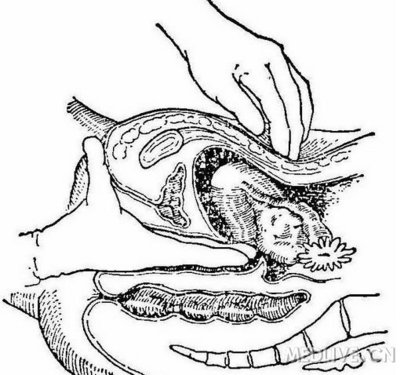妇科双合诊检查子宫双合诊检查子宫旁附件
