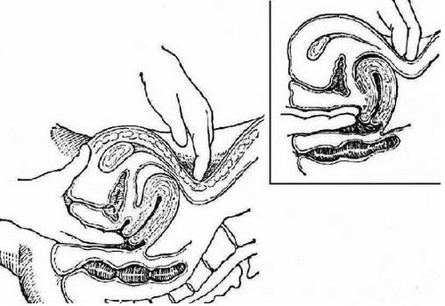 双合诊检查方法图