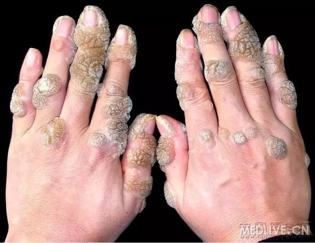 史上最全的皮肤病图谱吐血整理持续更新