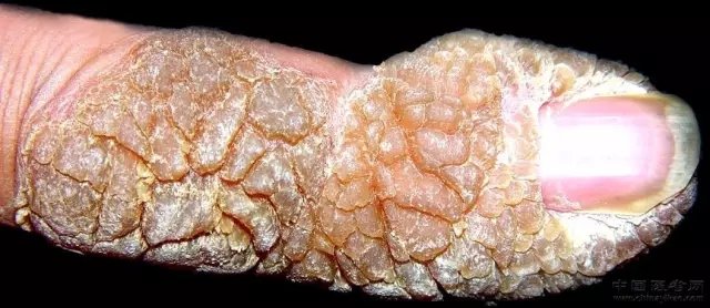 史上最全的皮肤病图谱吐血整理持续更新