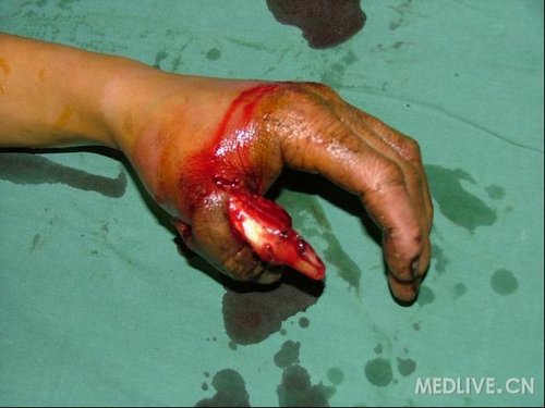 左拇指脱套伤有图