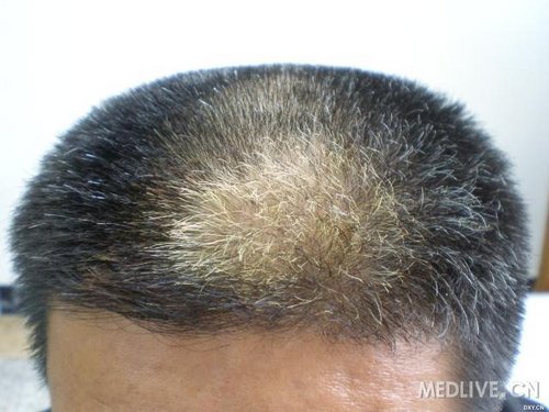 常见皮肤疾病典型图片