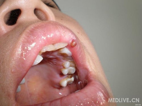 化脓性肉芽肿坏疽性脓皮病大疱性类天疱疮传染性软疣(成人型)