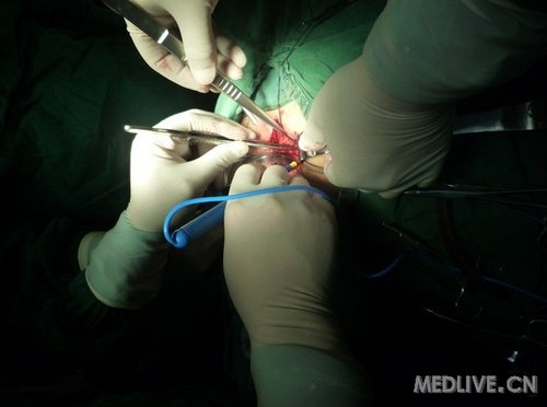 小儿直肠尿道瘘一例