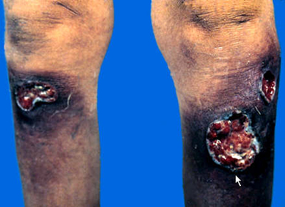 妊娠合并梅毒的母婴阻断