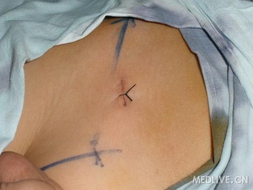 小切口治疗小儿鞘膜积液的一点体会