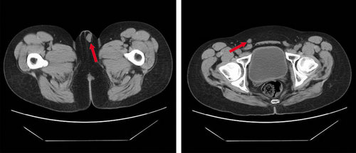 图7  下腹部ct:左侧小睾丸,右侧腹股沟隐睾(箭头所示).