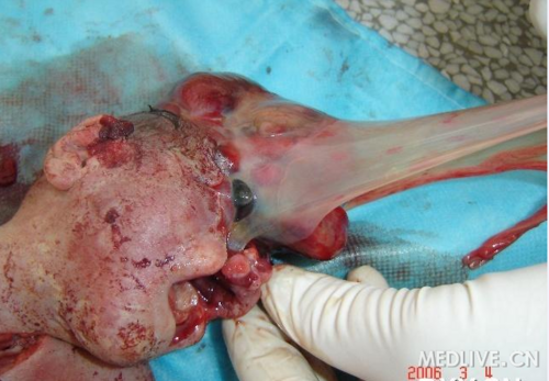 羊膜带综合征一例见图