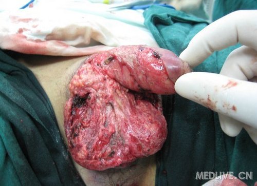 病例讨论精神失常自行用刀切割阴茎