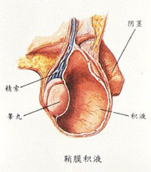 在体检时被偶然发现;积液量较多者常感到阴囊下垂,发胀,精索牵引痛等