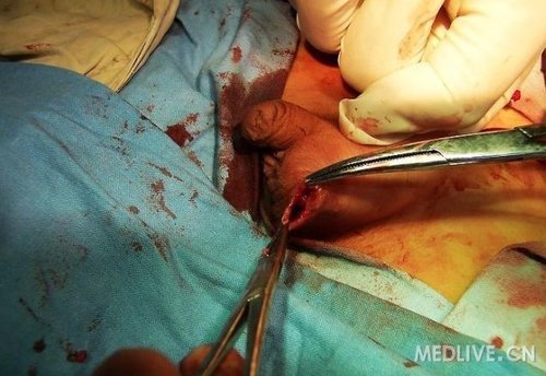睾丸摘除术 男人图片