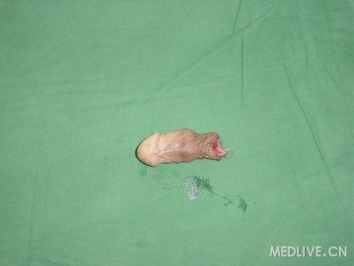 急诊一患者阴茎被人用利器割掉