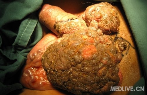 慎入阴囊阴茎根部肿块有病理