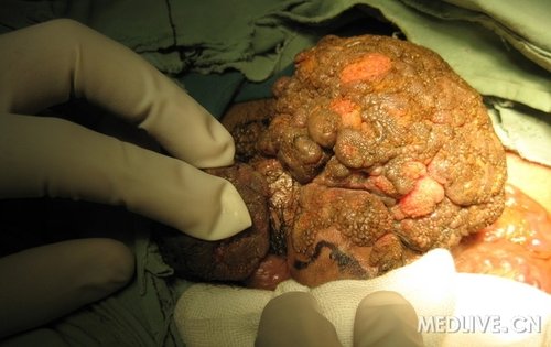 慎入阴囊阴茎根部肿块有病理