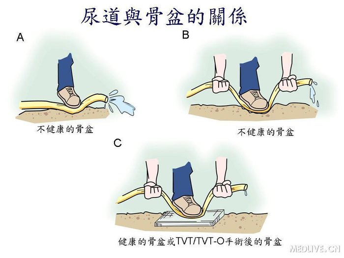 tvttvto治疗女性压力性尿失禁