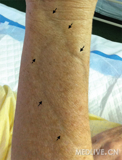 混合性结缔组织病57岁男性,一大片蓝色的皮肤,你觉得是啥造成的?a.